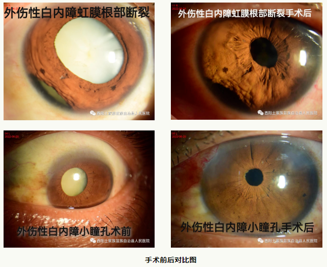 304.cam永利集团成功完成两例外伤性白内障手术