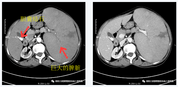 【乡村振兴】“组团式”帮扶 助力微创技术再创新篇——我院肝胆外科完成酉阳县首例腹腔镜巨脾切除术